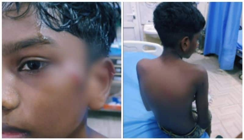 12 year old boy brutally attacked by a Rottweiler dog in chennai hospitalised