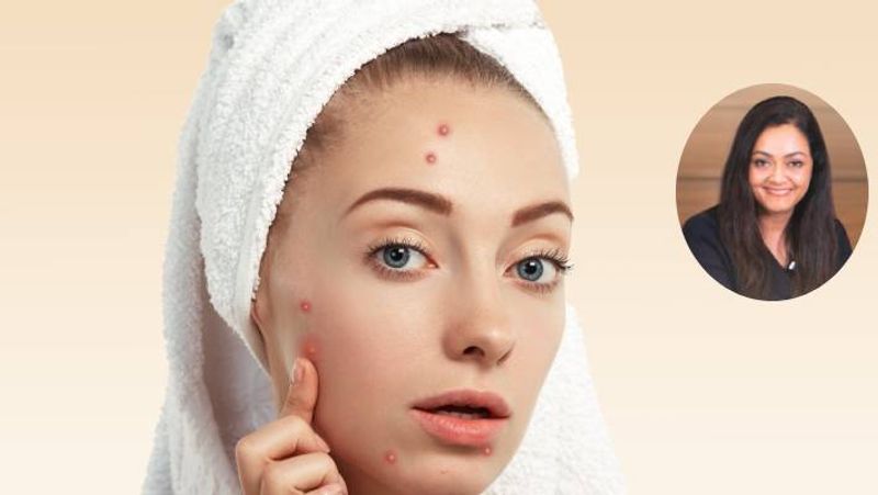 what does location of pimple on your face really says about your health in tamil mks