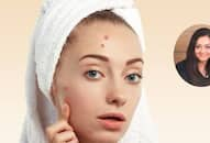  how can get rid of pimples know from Dr Rashmi Shetty Dermatologist Best Acne Treatments xbw