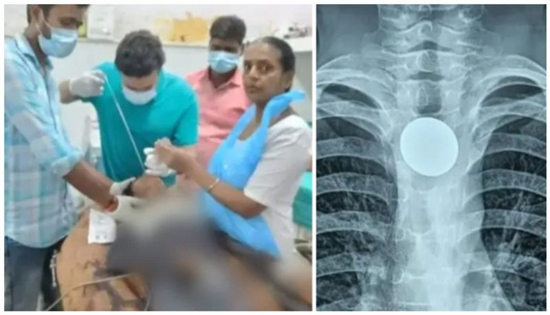 12 year old with throat pain came to district hospital and a coin he swallowed 7 year ago removed