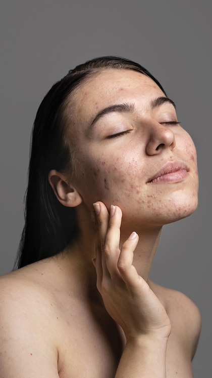 2. Oily Skin Treatment