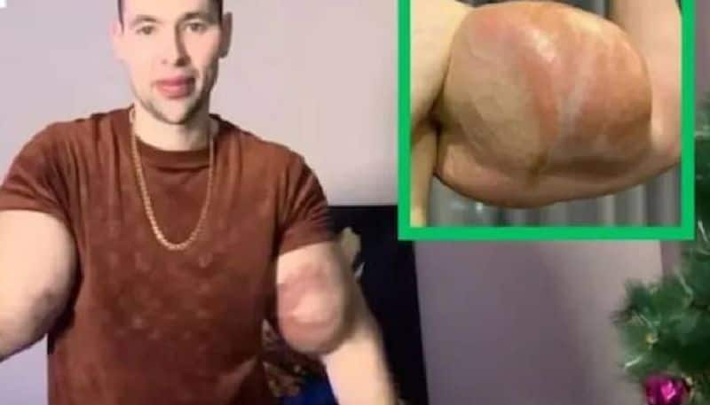 Russian man inject six litres of vaselin to bulk up biceps 