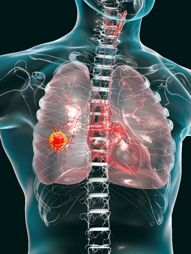 signs of lung cancer when should you worry