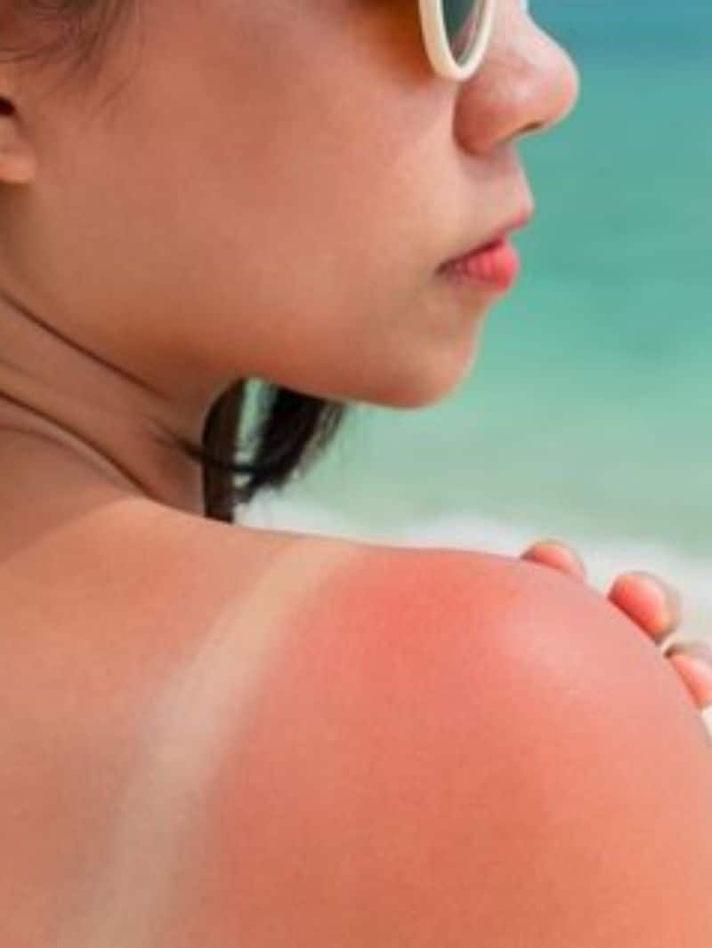 5 Effective home remedies for sunburn RTM EAI 