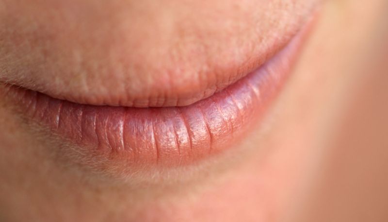 10 home remedies to beat chapped lips