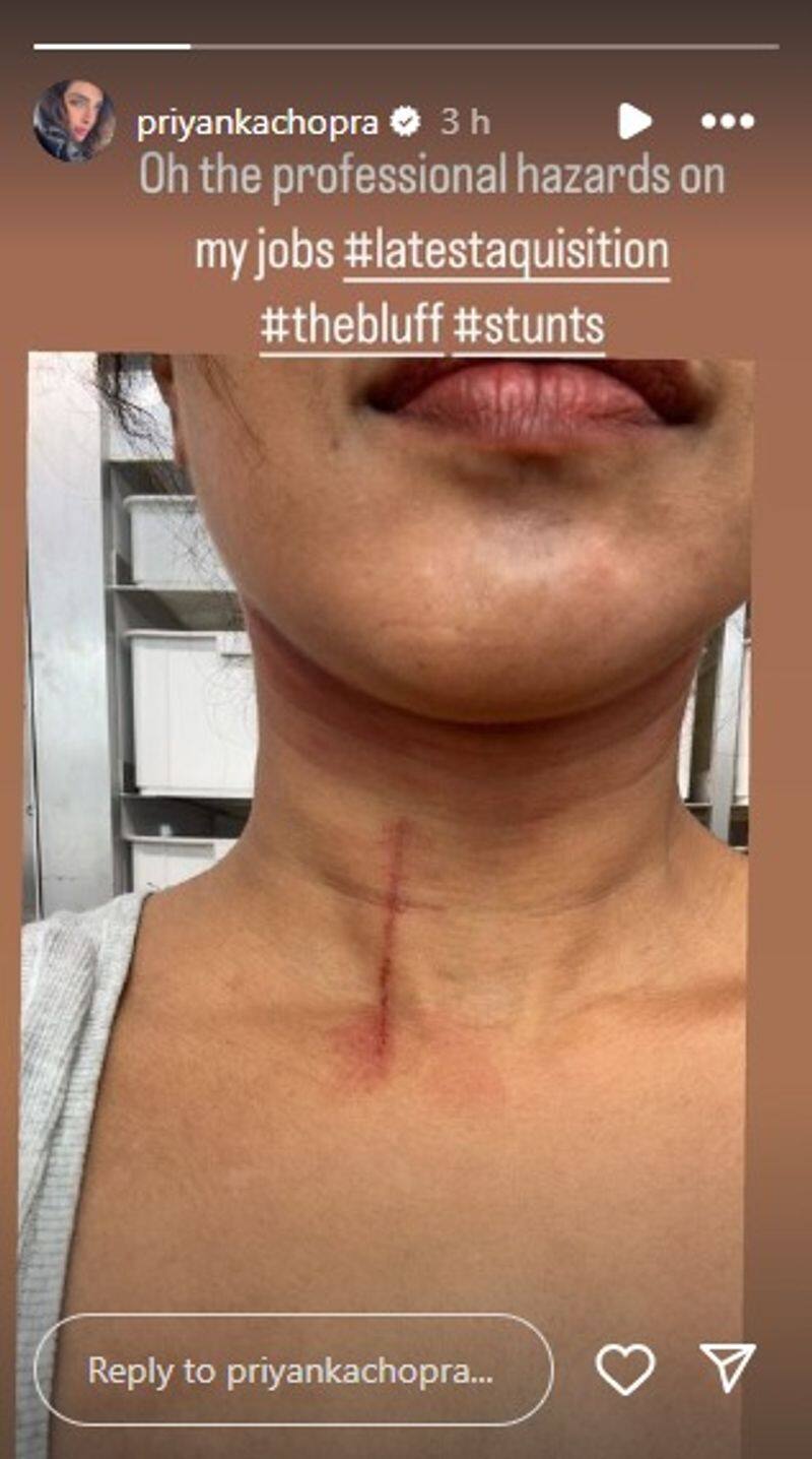 Priyanka Chopra gets injured while filming stunt, shares image of huge cut on her throat  RBA