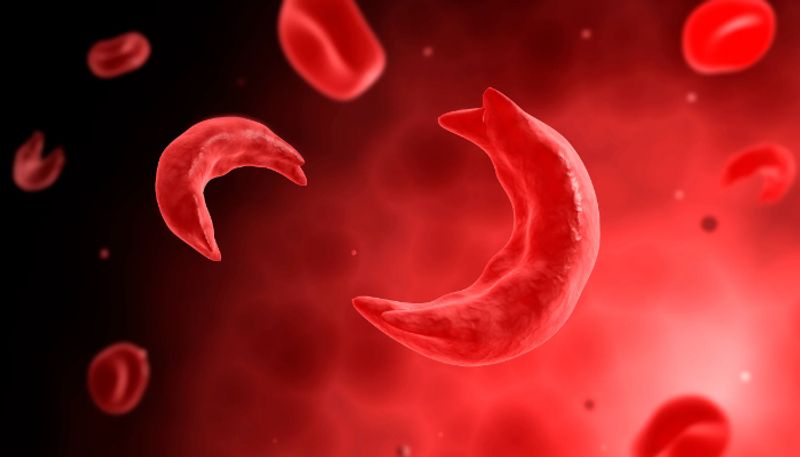 World Sickle Cell Awareness Day identifying sickle cell disease from early symptoms