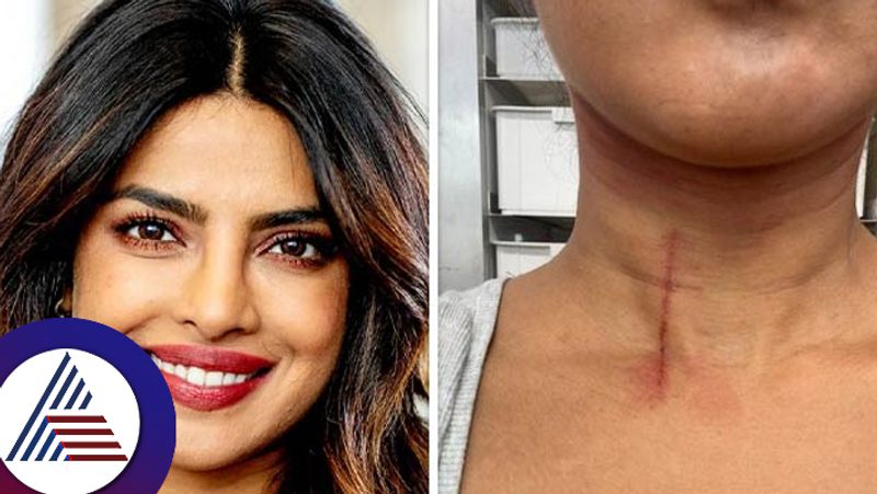 Priyanka Chopra gets injured on the sets of The Bluff shares pics of her wound 