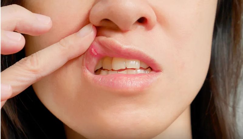 common foods that trigger mouth ulcers 