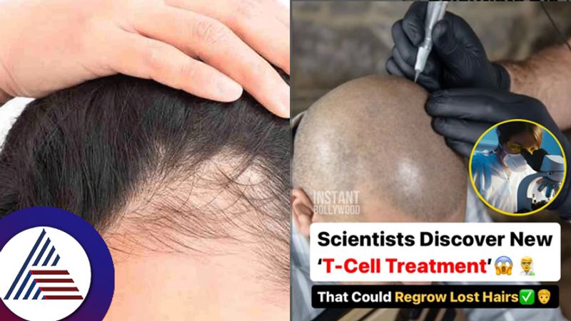 Scientists discovered a  treatment involving regulatory T Cells that could regrow lost hair suc