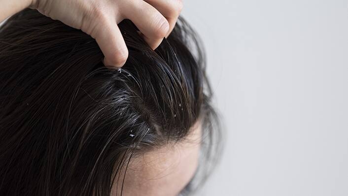 Jawed-Habib-diy-tips-for-severe-dandruff