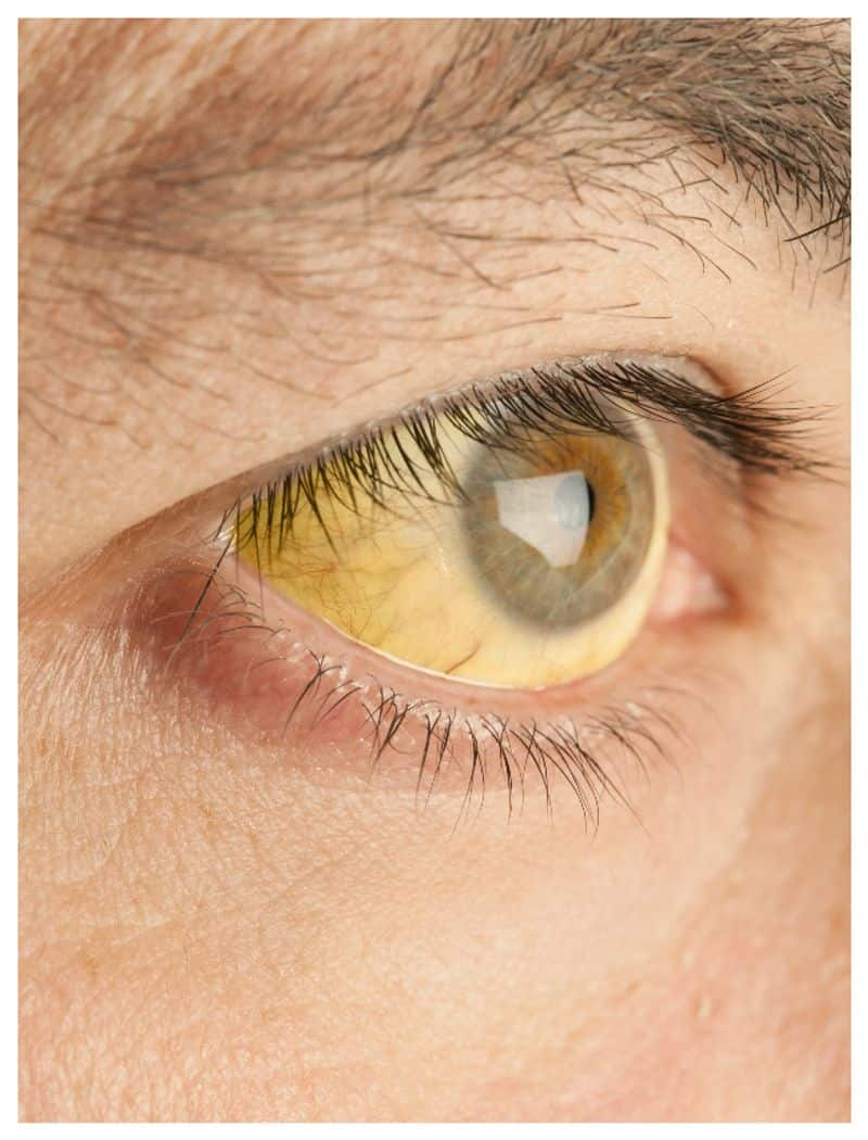 dont ignore jaundice symptoms