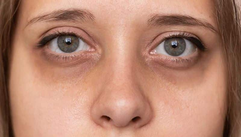 tips to remove dark circles at home