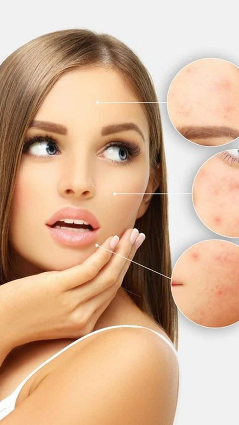 what pimples tell about your health problems in tamil mks