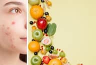  Special Diet for acne supplement research