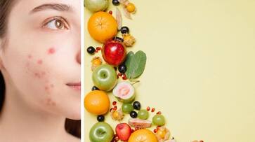  Special Diet for acne supplement research