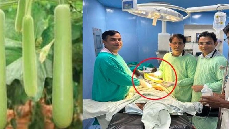 Madhya Pradesh doctors removed a 16 inch bottle gourd from the farmers rectum akb