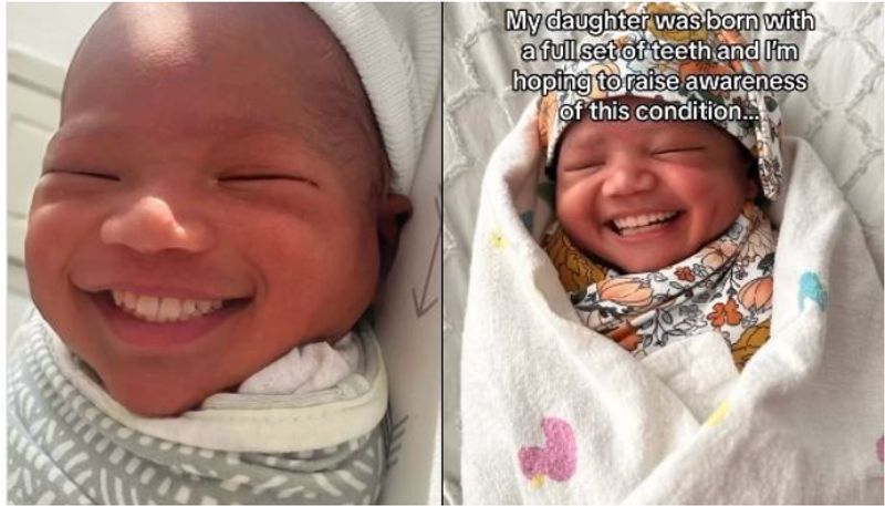 viral video of baby born with 32 teeth know this rare condition 