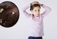 Simple and effective dandruff treatments for kids iwh