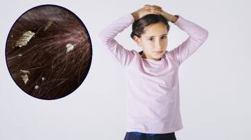 Simple and effective dandruff treatments for kids iwh