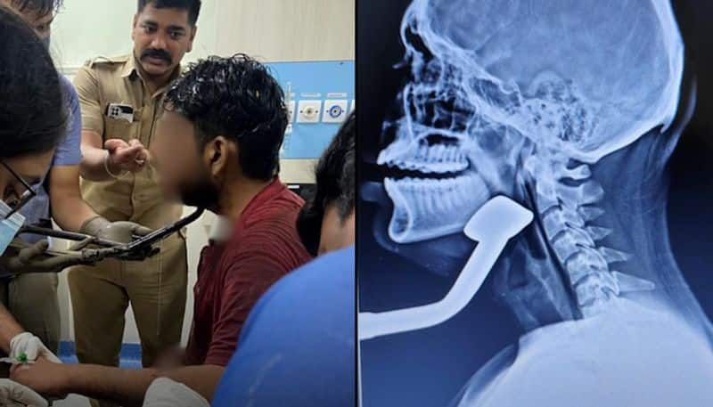 Pune teen critically injured as scooter stand penetrates neck in bus accident, docs successfully remove it snt