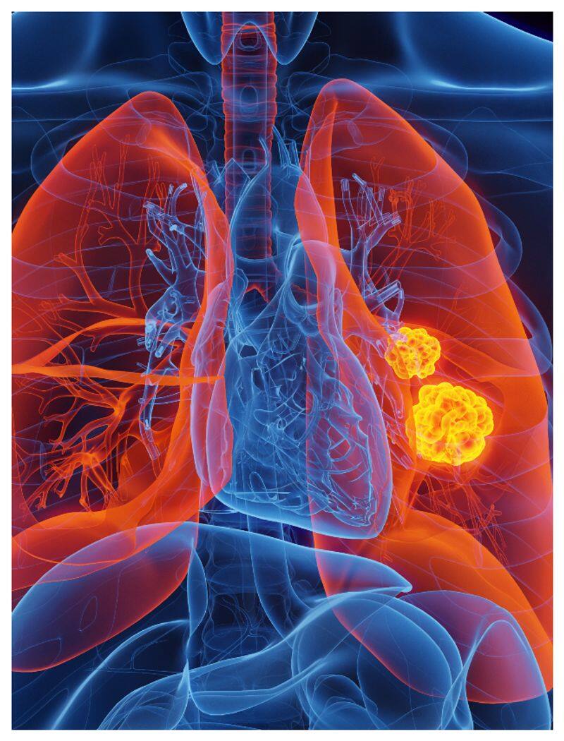 world lung cancer day signs and symptoms of lung cancer