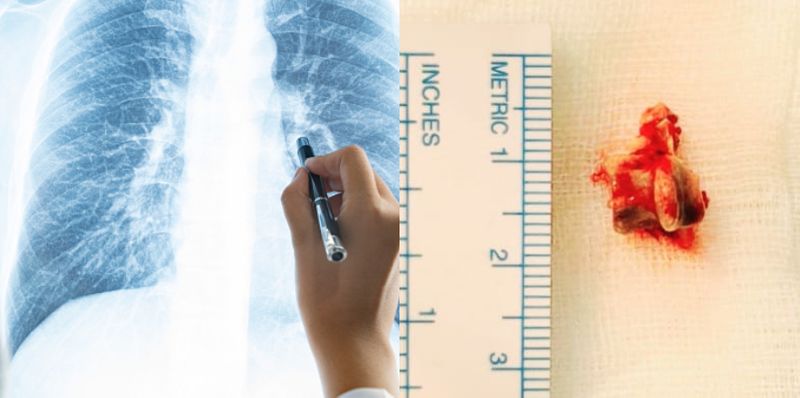 62 year old man relived from 3 year old cough and breathing issues after removing chicken bone from lungs