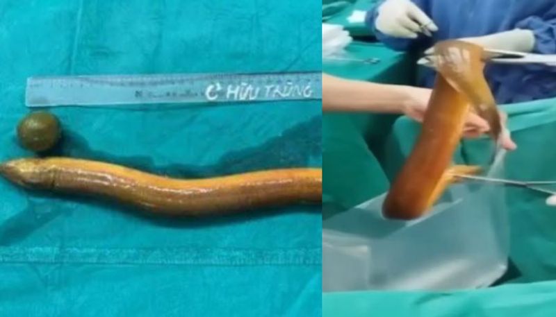 shocking news of indian man inserted 2 foot live eel in anus  