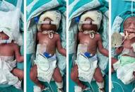  woman gives birth to four babies know  Multiple Births complications