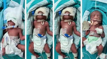  woman gives birth to four babies know  Multiple Births complications