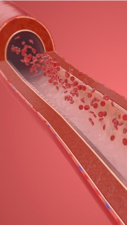 Iron Deficiency Problems