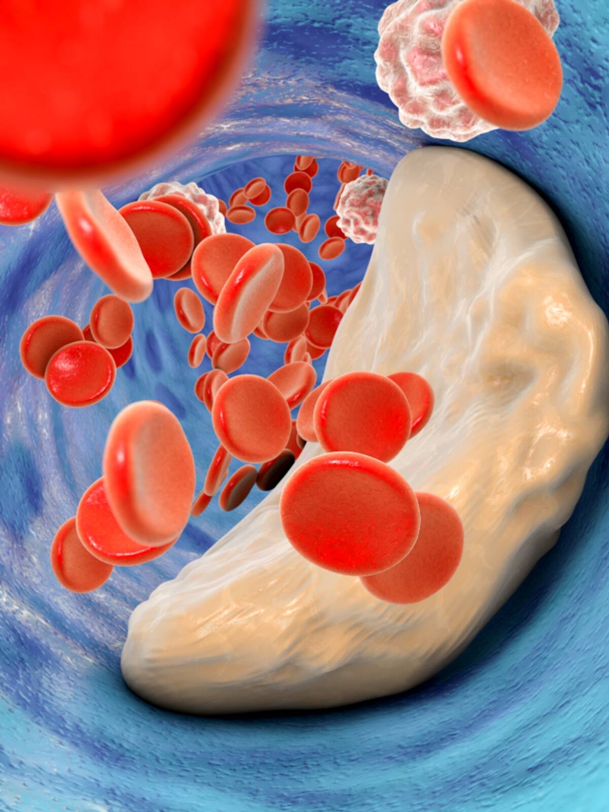 signs of high cholesterol in men