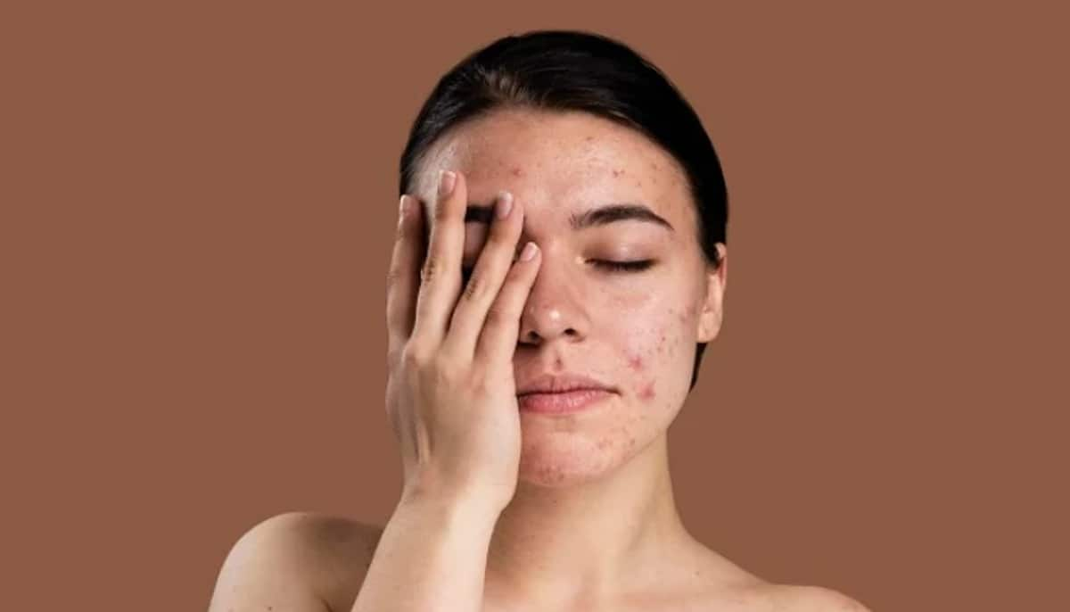 home made remedies for dark spots on the skin