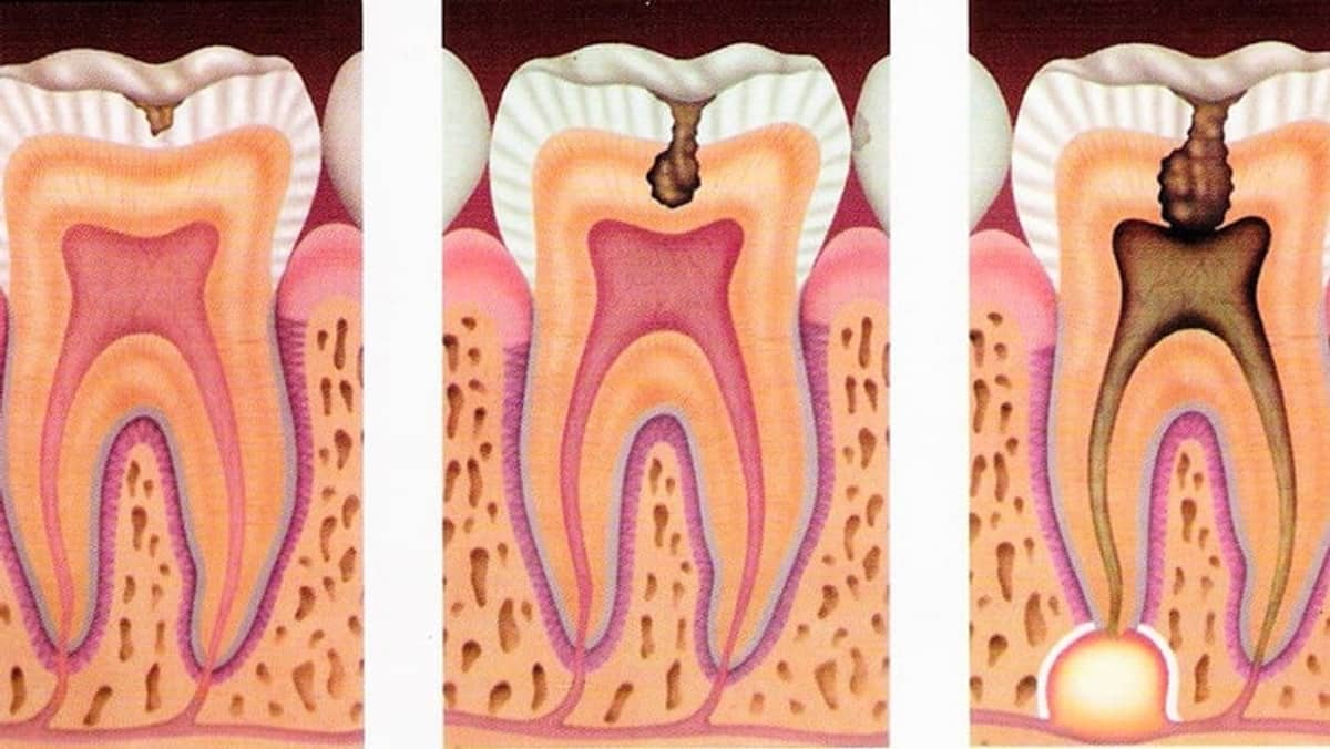 How Missing Teeth Can Increase Risk of Heart Disease: Key Insights GVR