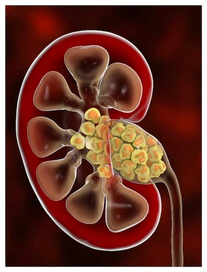 Kidney stones:   ఈ లక్షణాలు ఉంటే.. కిడ్నీలో రాళ్లు ఉన్నట్టే!