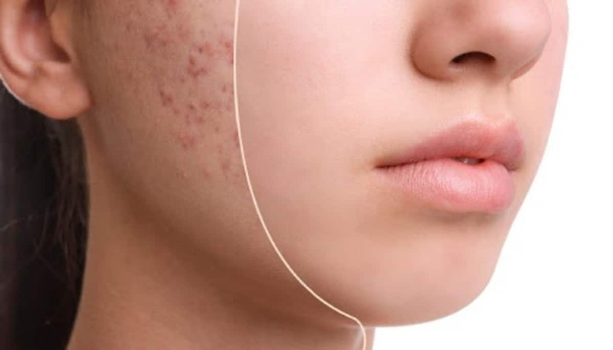 These hacks can help you reduce Pimple spots 