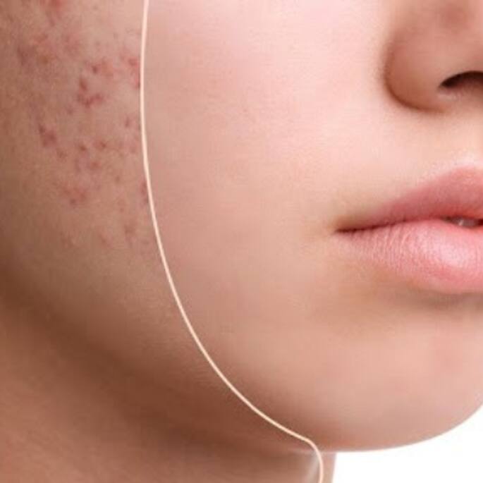 Beauty Tips: ఇలా చేస్తే..ఒక్కరోజులో మొటిమలు మాయం..!