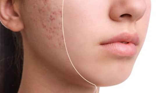 How to Reduce Acne: पिंपल से भर गया चेहरा? 6 तरीके से करें साफ