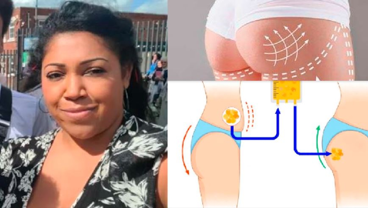 cosmetic surgery goes wrong British woman dies during Brazilian butt lift surgery in Turkey akb