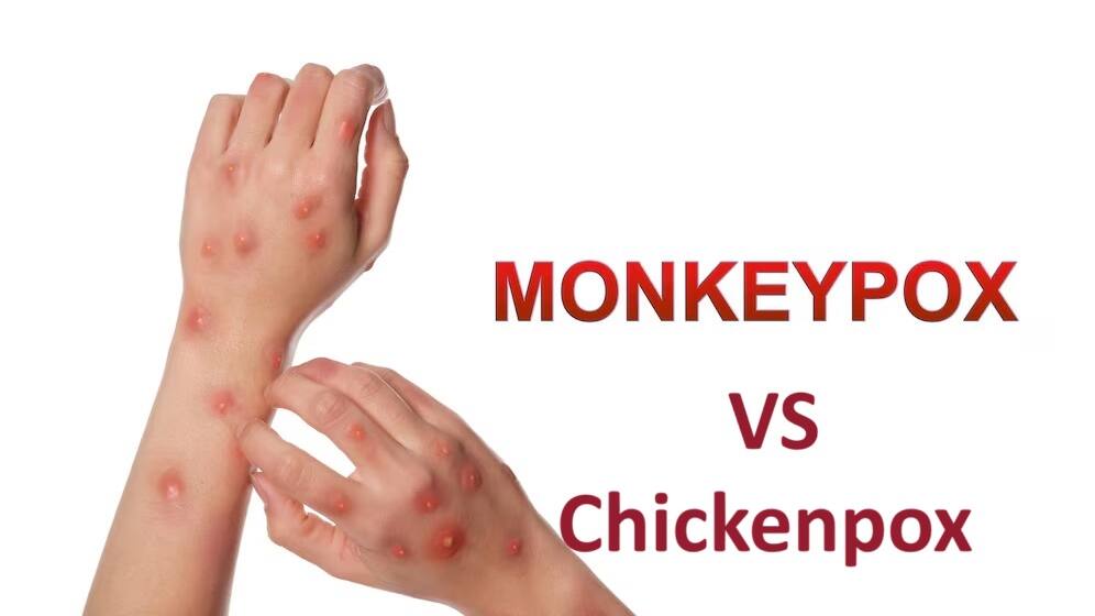 Monkeypox vs chickenpox