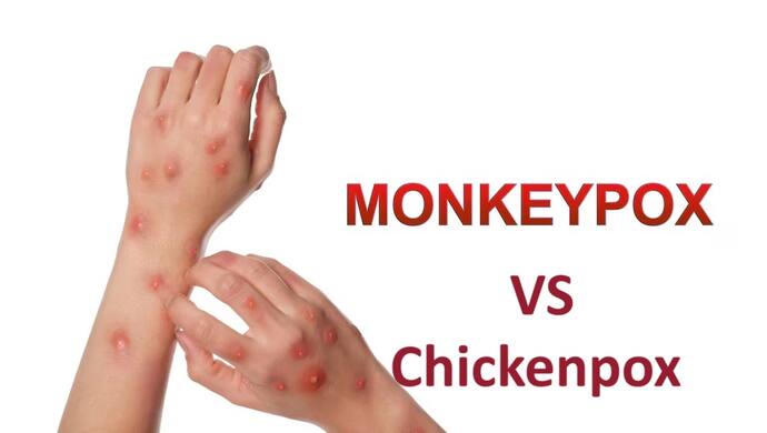 Monkeypox vs chickenpox