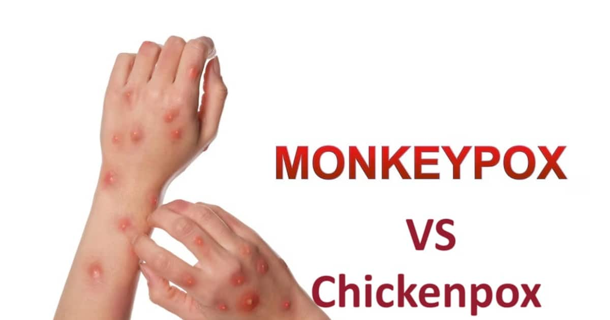 Monkeypox vs chickenpox: Transmission to vaccine, 7 difference all MUST ...