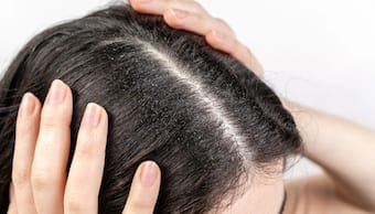 Fight dandruff with lemon: Here's how to use it effectively