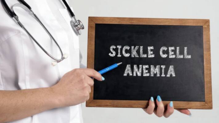  Sickle cell anemia 1