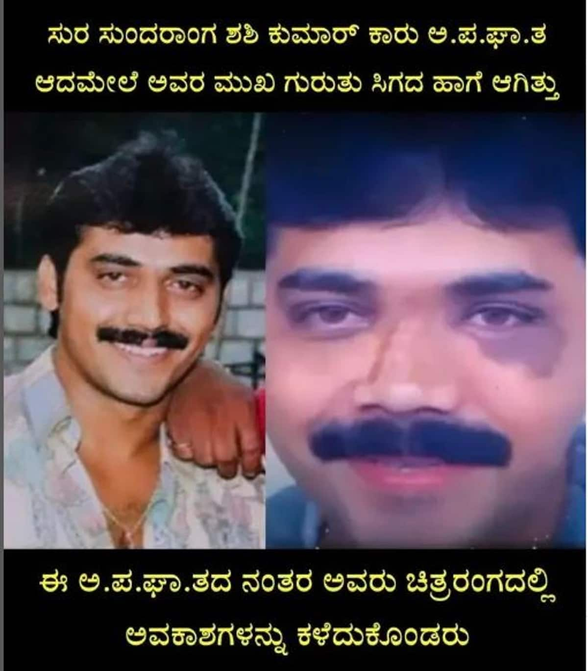 Kannada actor Shashikumar face transformation photo after accident goes viral vcs