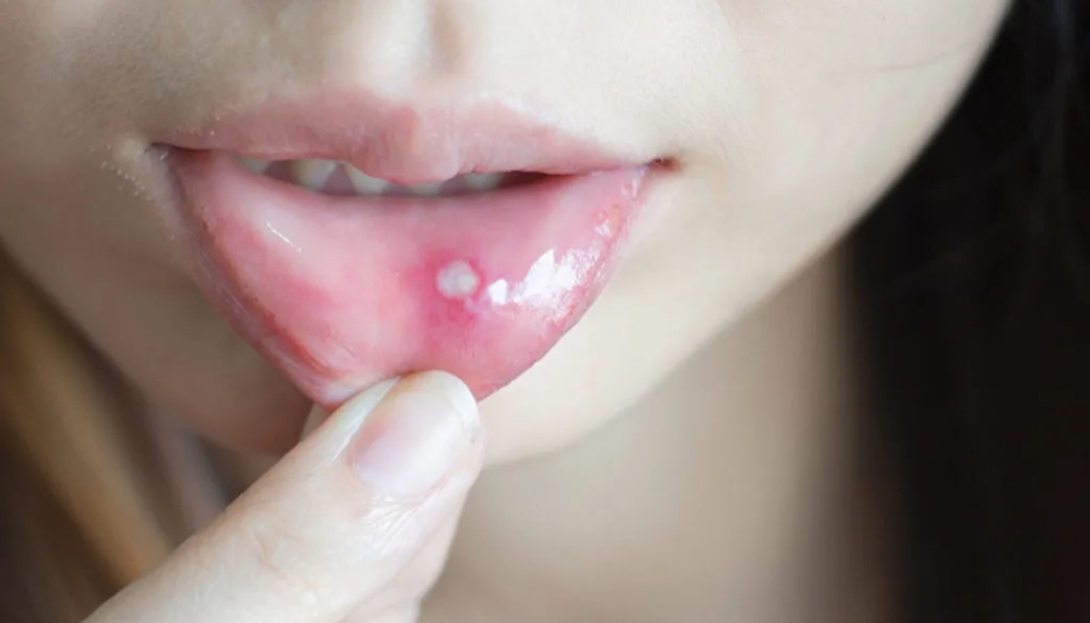 home remedies to cure mouth ulcers