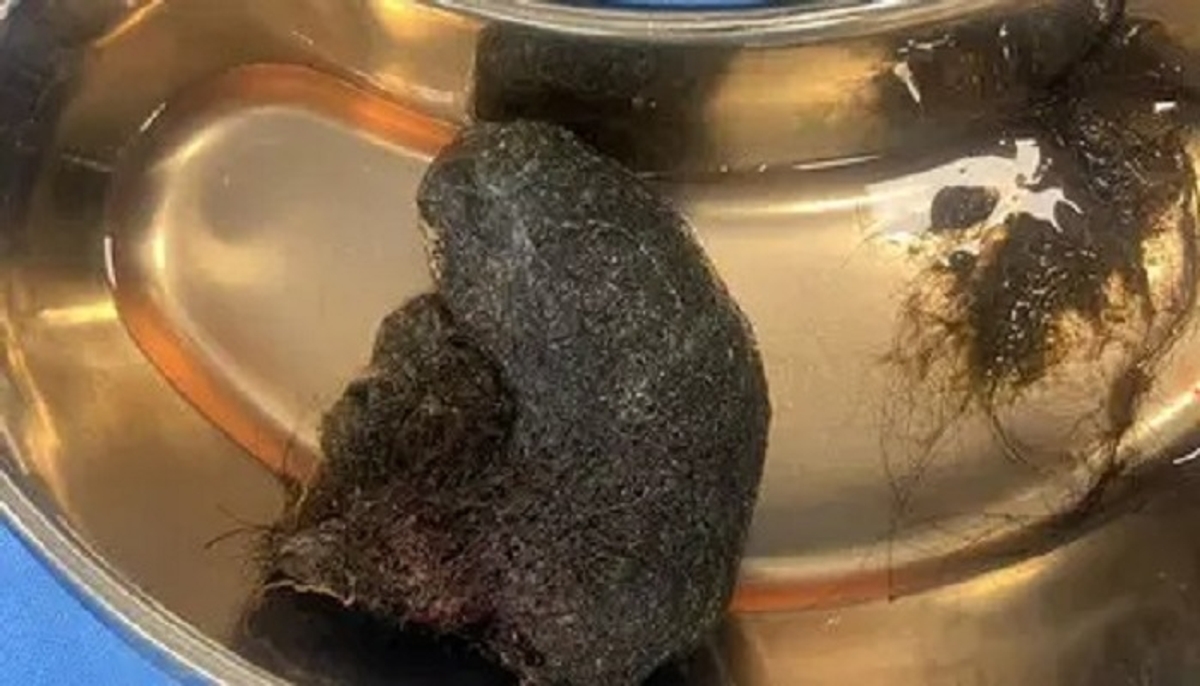 Bengaluru Doctors removed a massive hairball from the stomach of an 8 year old girl san