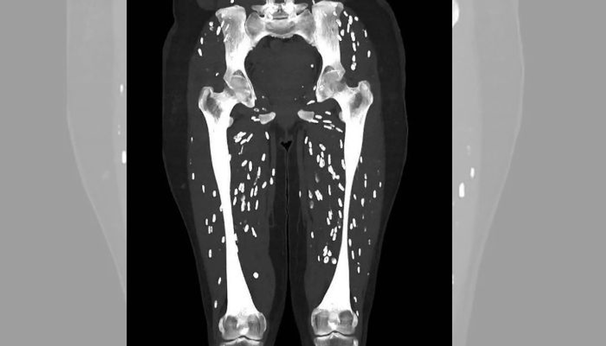 Doctors shocked after seeing the ct scan of a person who ate half cooked pork meat mrq