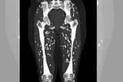 Doctors shocked after seeing the ct scan of a person who ate half cooked pork meat mrq