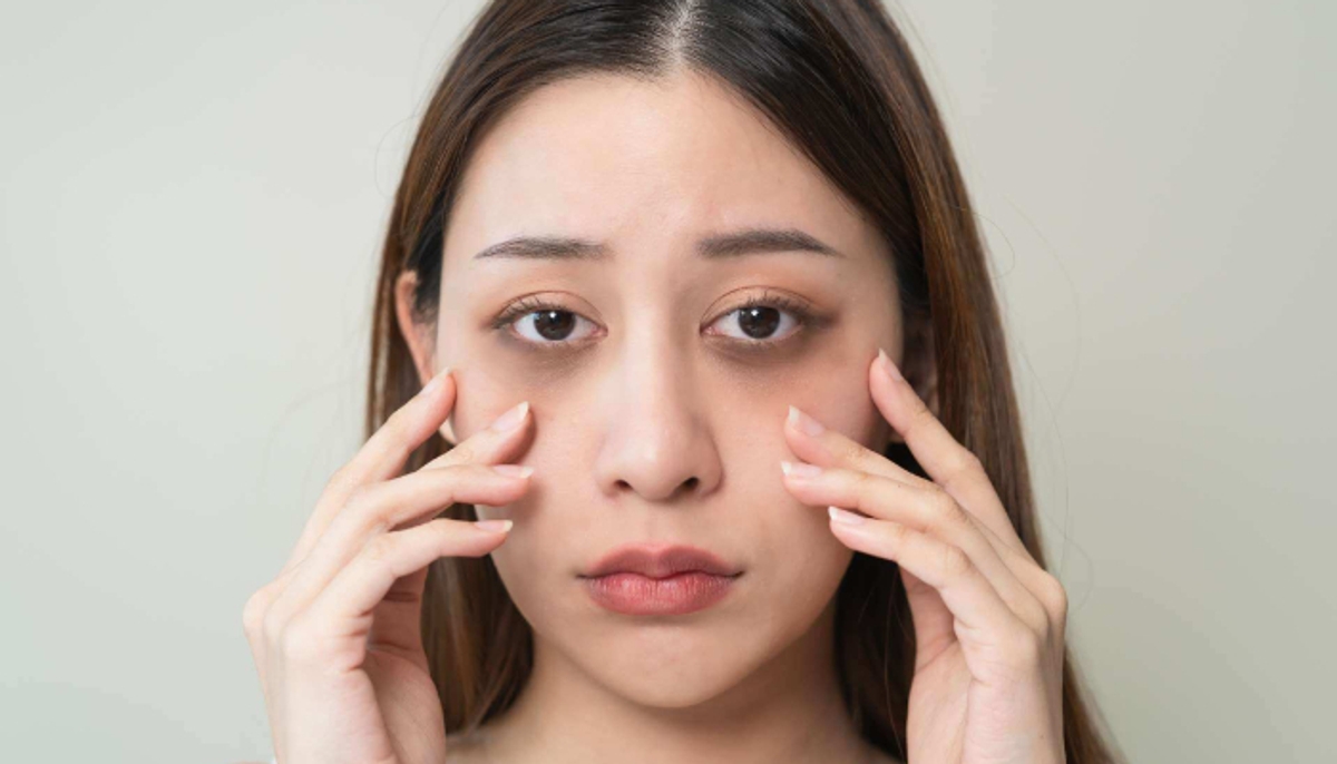 Try these natural remedies to get rid of dark circles